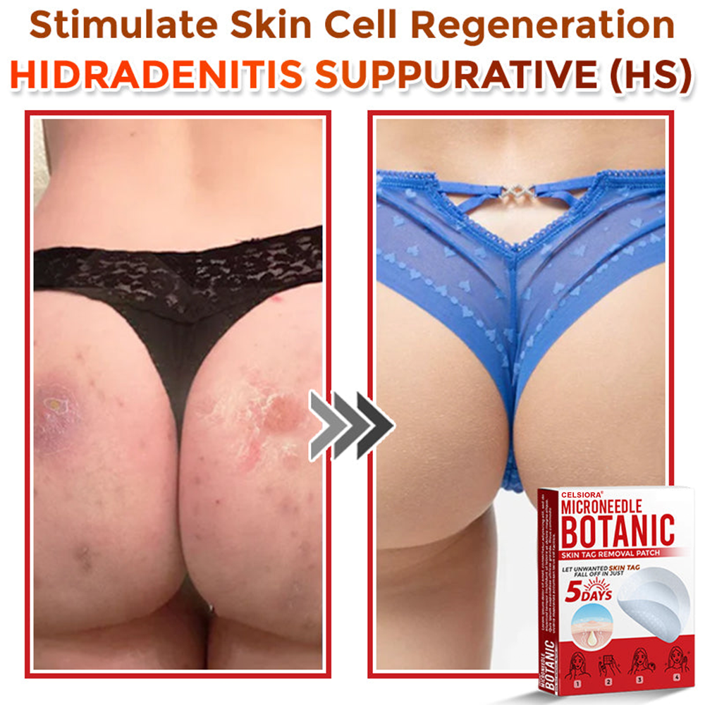 upsell🎀Celsiora® 2-in-1 Microneedle & Hydrocolloid Patch | Raised Moles,Acne,  Flat Warts & Skin Tags Remover | Improves Wrinkles, Scars & Blemishes | Invisible Pimple Patches for Face & Body