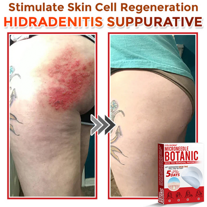 upsell🎀Celsiora® 2-in-1 Microneedle & Hydrocolloid Patch | Raised Moles,Acne,  Flat Warts & Skin Tags Remover | Improves Wrinkles, Scars & Blemishes | Invisible Pimple Patches for Face & Body