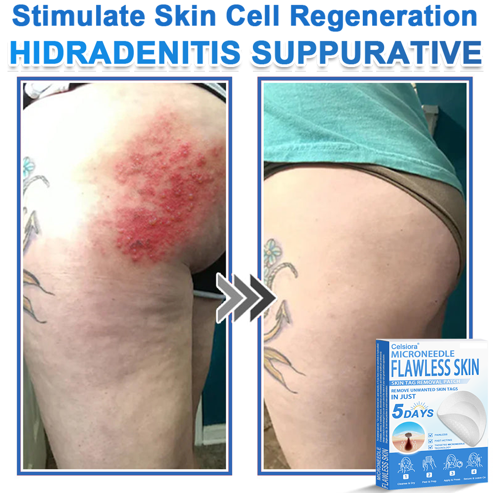 🗽Celsiora® 2-in-1 Microneedle & Hydrocolloid Patch | Raised Moles,Acne,  Flat Warts & Skin Tags Remover | Improves Wrinkles, Scars & Blemishes | Invisible Pimple Patches for Face & Body (Copy)