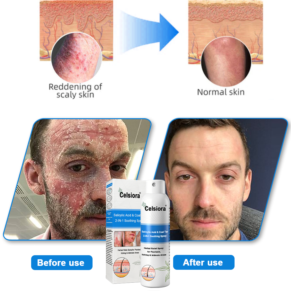 Psoriasis✅ Official Store: Celsiora® SALICYLIC ACID& COAL TAR 2-IN-1 Psoriasis Spray 👨‍⚕️ Developed by Dermatologists (for the treatment of psoriasis and eczema, improvement of bacterial infections in the genital area) Made in USA