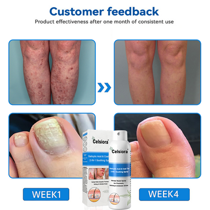 Psoriasis✅ Official Store: Celsiora® SALICYLIC ACID& COAL TAR 2-IN-1 Psoriasis Spray 👨‍⚕️ Developed by Dermatologists (for the treatment of psoriasis and eczema, improvement of bacterial infections in the genital area) Made in USA