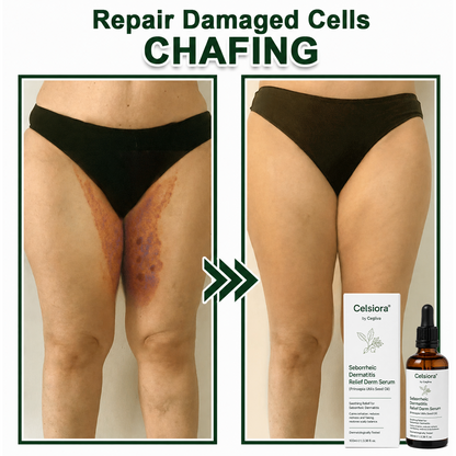 🍀Celsiora® Seborrheic Dermatitis Relief Derm Serum