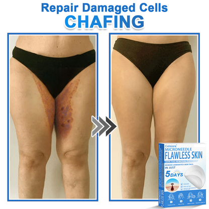 🗽Celsiora® 2-in-1 Microneedle & Hydrocolloid Patch | Raised Moles,Acne,  Flat Warts & Skin Tags Remover | Improves Wrinkles, Scars & Blemishes | Invisible Pimple Patches for Face & Body (Copy)