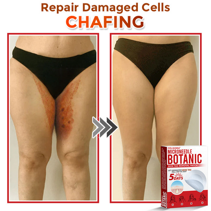upsell🎀Celsiora® 2-in-1 Microneedle & Hydrocolloid Patch | Raised Moles,Acne,  Flat Warts & Skin Tags Remover | Improves Wrinkles, Scars & Blemishes | Invisible Pimple Patches for Face & Body