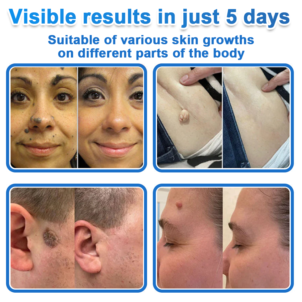 🗽Celsiora® 2-in-1 Microneedle & Hydrocolloid Patch | Raised Moles,Acne,  Flat Warts & Skin Tags Remover | Improves Wrinkles, Scars & Blemishes | Invisible Pimple Patches for Face & Body (Copy)