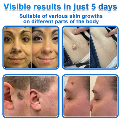 🗽Celsiora® 2-in-1 Microneedle & Hydrocolloid Patch | Raised Moles,Acne,  Flat Warts & Skin Tags Remover | Improves Wrinkles, Scars & Blemishes | Invisible Pimple Patches for Face & Body (Copy)