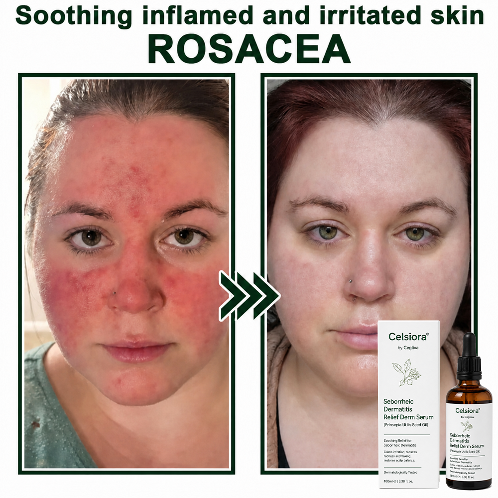 🍀Celsiora® Seborrheic Dermatitis Relief Derm Serum