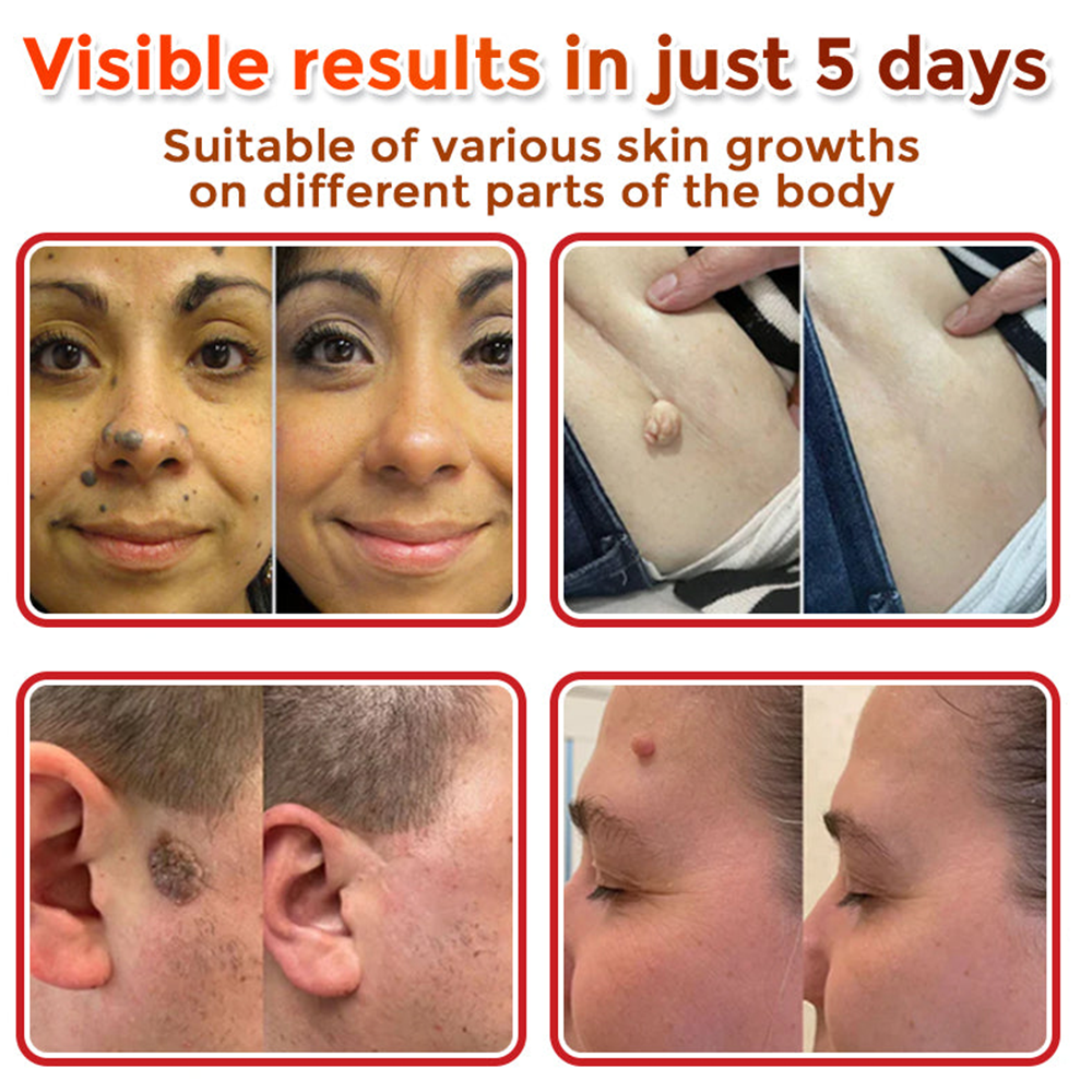 upsell🎀Celsiora® 2-in-1 Microneedle & Hydrocolloid Patch | Raised Moles,Acne,  Flat Warts & Skin Tags Remover | Improves Wrinkles, Scars & Blemishes | Invisible Pimple Patches for Face & Body