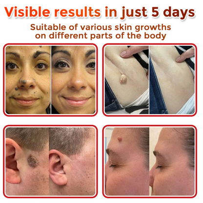 upsell🎀Celsiora® 2-in-1 Microneedle & Hydrocolloid Patch | Raised Moles,Acne,  Flat Warts & Skin Tags Remover | Improves Wrinkles, Scars & Blemishes | Invisible Pimple Patches for Face & Body