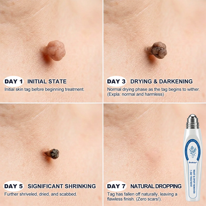 Made and Shipped from USA ✨Evolvion® 𝟕-𝐃𝒂𝘆 𝐒𝗸𝐢𝐧 𝐓𝒂𝗴 & 𝐒𝐩𝙤𝐭 𝐄𝐫𝒂𝐬𝙚𝐫 Painless & Scar-Free Advanced Imperfection Remova𝗜 Ro𝗜𝗜erba𝗜𝗜 Pen 🌵 🌵