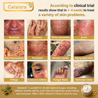 🌸Celsiora® 🌸Organic Tallow Honey Balm to Help Helps remove warts, skin tags, and psoriasis