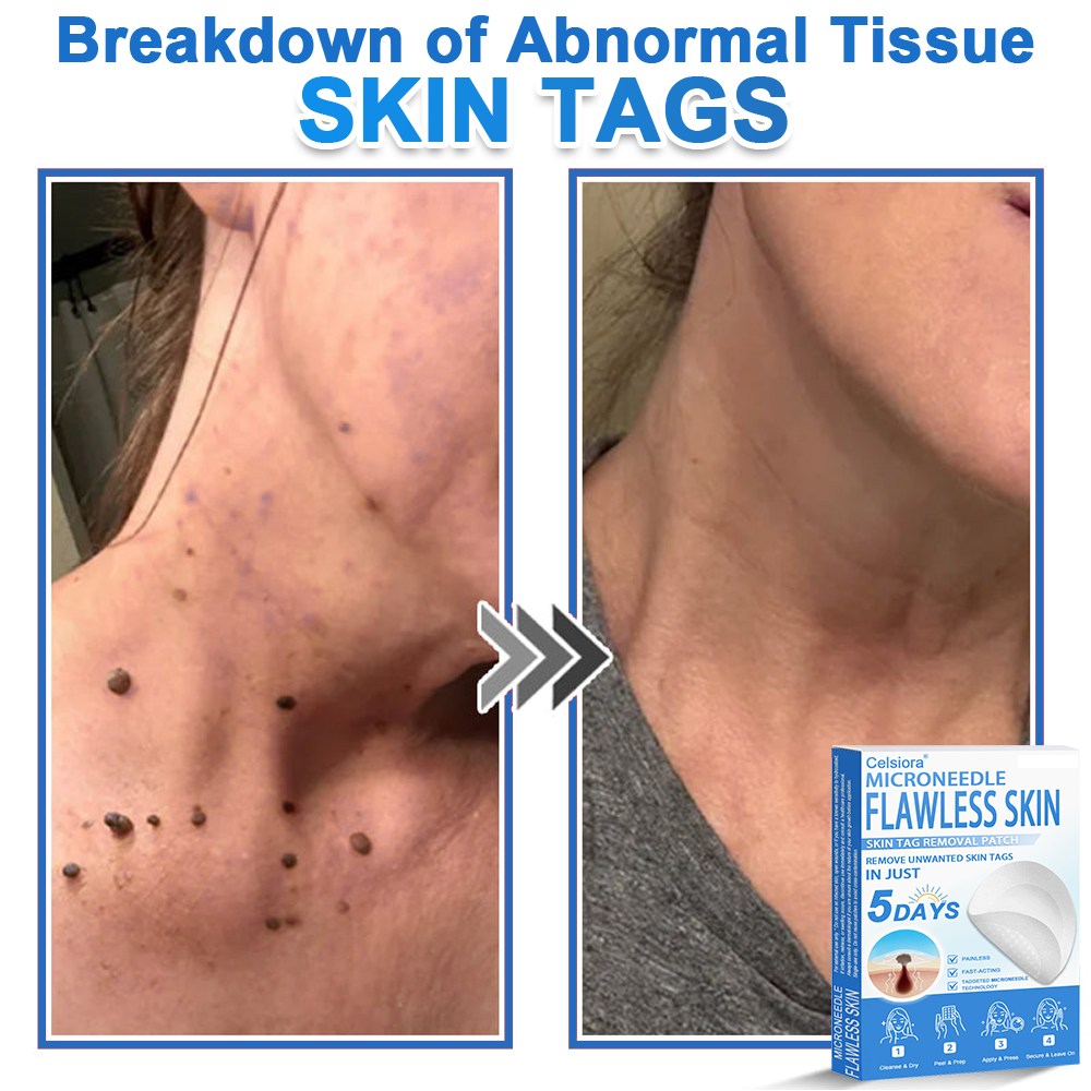 🗽Celsiora® 2-in-1 Microneedle & Hydrocolloid Patch | Raised Moles,Acne,  Flat Warts & Skin Tags Remover | Improves Wrinkles, Scars & Blemishes | Invisible Pimple Patches for Face & Body (Copy)