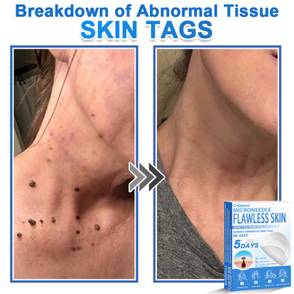 🗽Celsiora® 2-in-1 Microneedle & Hydrocolloid Patch | Raised Moles,Acne,  Flat Warts & Skin Tags Remover | Improves Wrinkles, Scars & Blemishes | Invisible Pimple Patches for Face & Body (Copy)