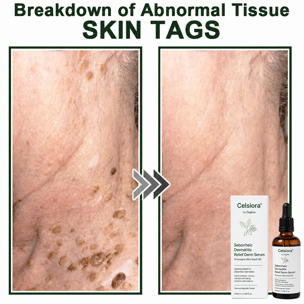 🍀Celsiora® Seborrheic Dermatitis Relief Derm Serum