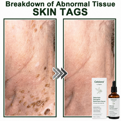 🍀Celsiora® Seborrheic Dermatitis Relief Derm Serum