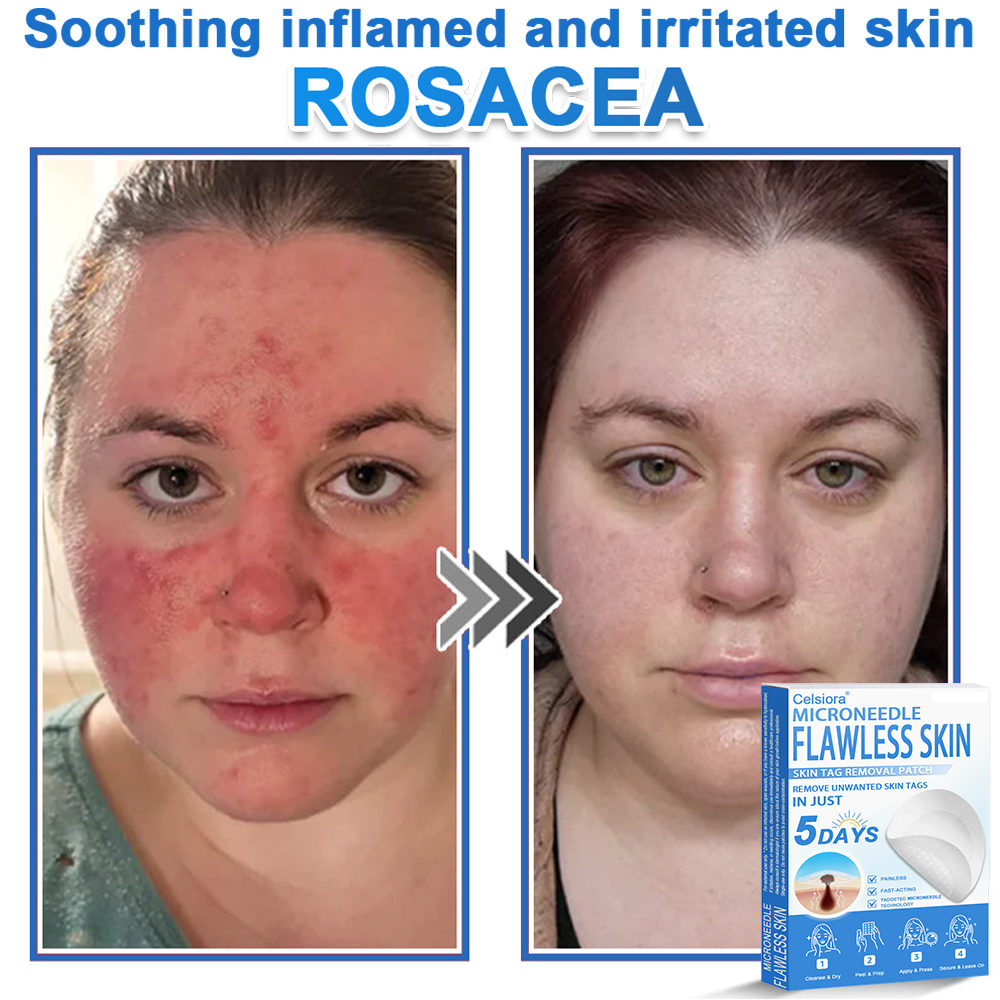 🗽Celsiora® 2-in-1 Microneedle & Hydrocolloid Patch | Raised Moles,Acne,  Flat Warts & Skin Tags Remover | Improves Wrinkles, Scars & Blemishes | Invisible Pimple Patches for Face & Body (Copy)