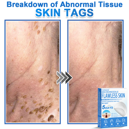 🗽Celsiora® 2-in-1 Microneedle & Hydrocolloid Patch | Raised Moles,Acne,  Flat Warts & Skin Tags Remover | Improves Wrinkles, Scars & Blemishes | Invisible Pimple Patches for Face & Body (Copy)