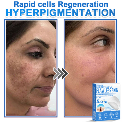 🗽Celsiora® 2-in-1 Microneedle & Hydrocolloid Patch | Raised Moles,Acne,  Flat Warts & Skin Tags Remover | Improves Wrinkles, Scars & Blemishes | Invisible Pimple Patches for Face & Body (Copy)