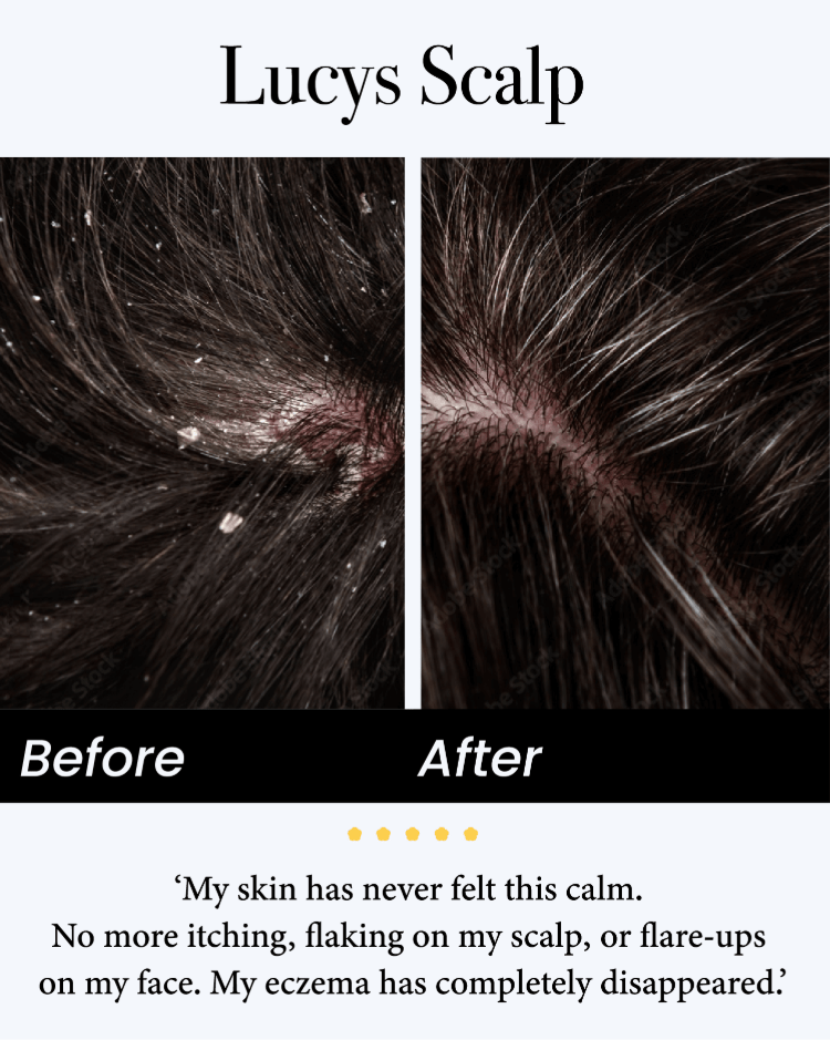🍀Celsiora® Seborrheic Dermatitis Relief Derm Serum