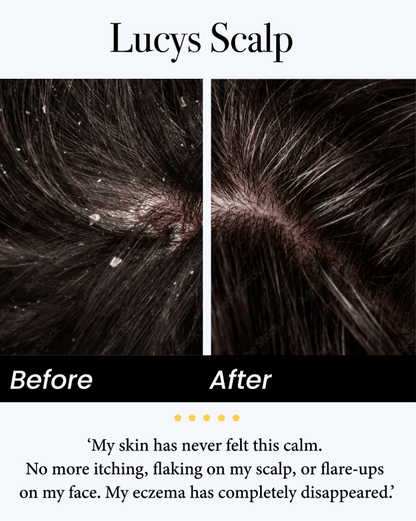 🍀Celsiora® Seborrheic Dermatitis Relief Derm Serum