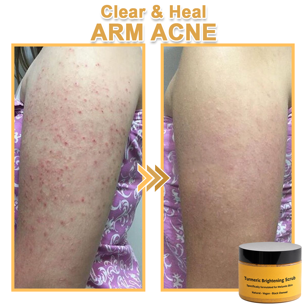 ✨️BUY 2 GET 1 FREE✨️Turmeric Exfoliating For Face & Body Scrub-Celsiora®